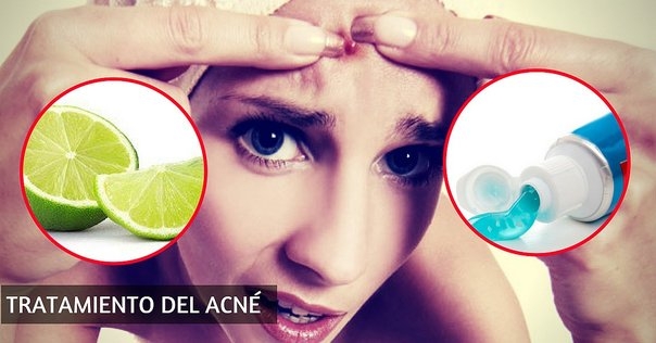 remedios-caseros-para-el-acne-833675-281611-jpg_604x0.jpg