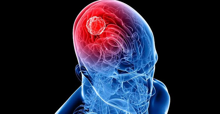 tumor-cerebral.jpg