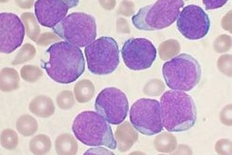 245px-Acute_leukemia-ALL.jpg