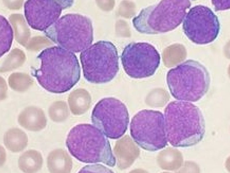 245px-Acute_leukemia-ALL.jpg