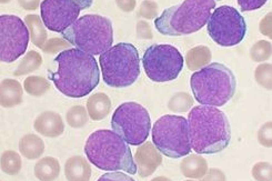 245px-Acute_leukemia-ALL.jpg