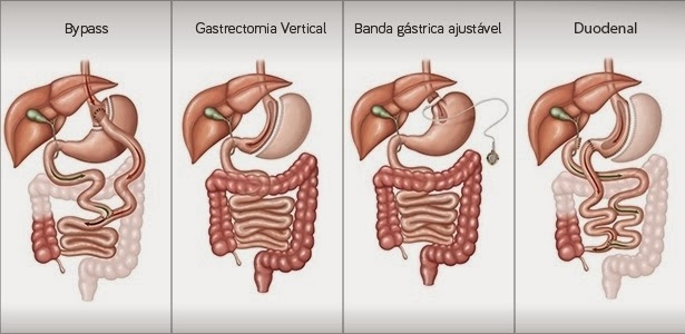 tecnicas-de-cirurgia-bariatrica-e-metabolica-aprovadas-no-brasil-1392657352356_615x300.jpg