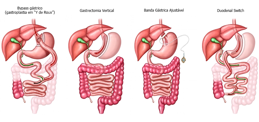 verdades-e-mentiras-sobre-cirurgia-da-obesidade-06112017103357.jpg