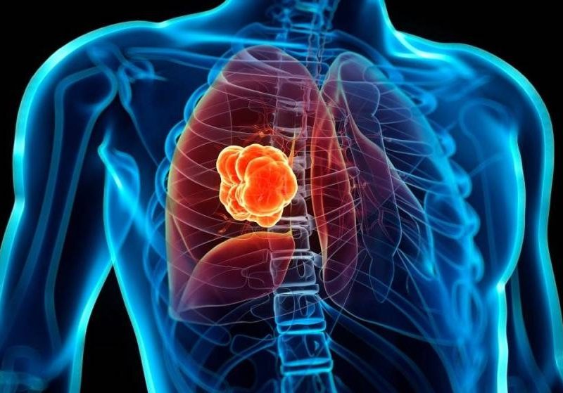 que-posibilidades-hay-de-heredar-un-cancer-de-pulmon.jpg