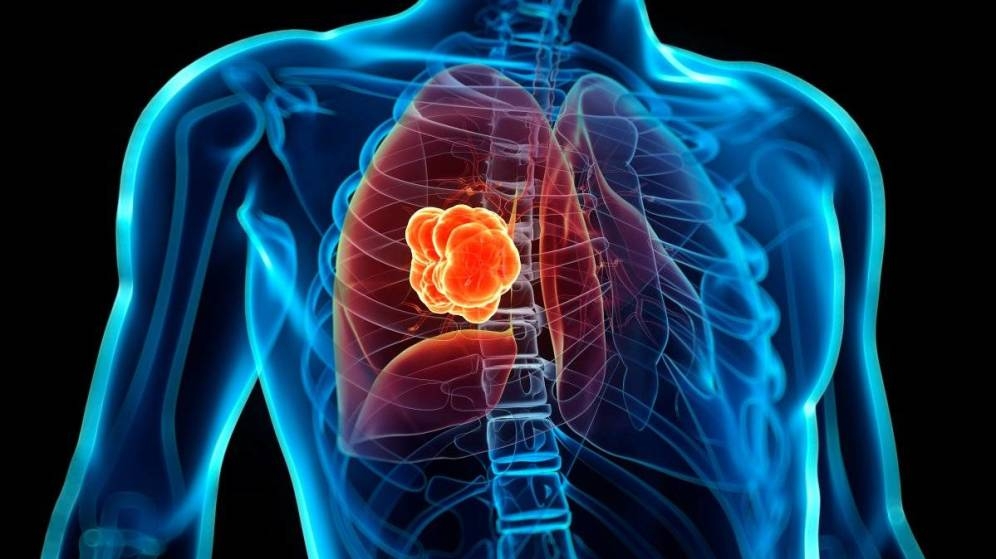 que-posibilidades-hay-de-heredar-un-cancer-de-pulmon.jpg