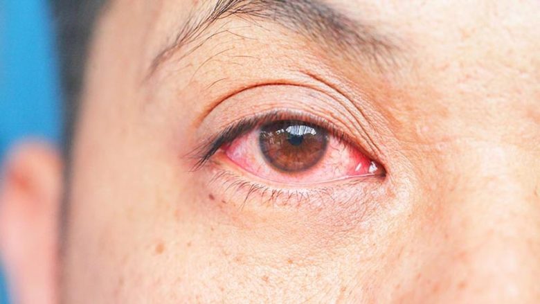 conjuntivitis.jpg