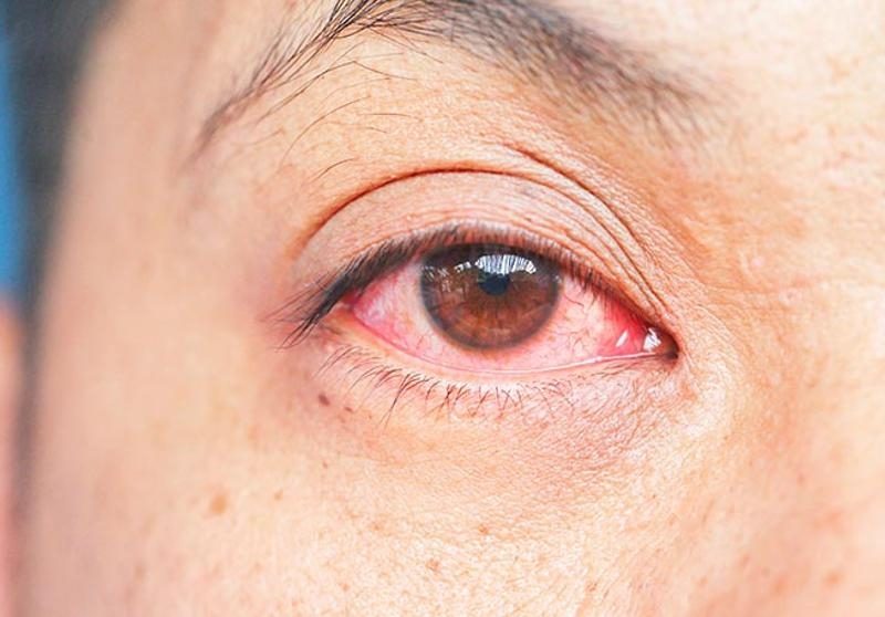conjuntivitis.jpg