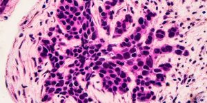 cancer-mama_5e9aa36e_567745189_240215110808_800x534.jpg