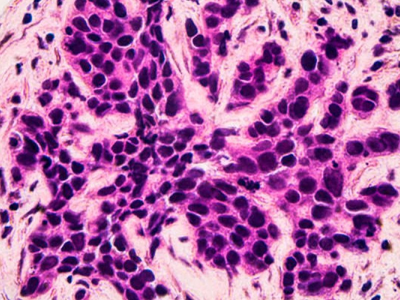 cancer-mama_5e9aa36e_567745189_240215110808_800x534.jpg