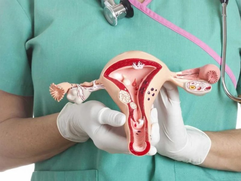 CÁNCER DE OVARIO.jpg