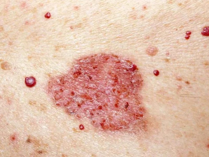 CARCINOMA.jpg