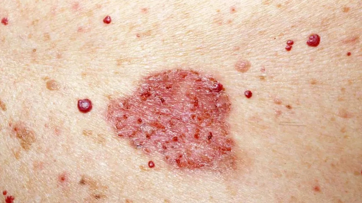 CARCINOMA.jpg