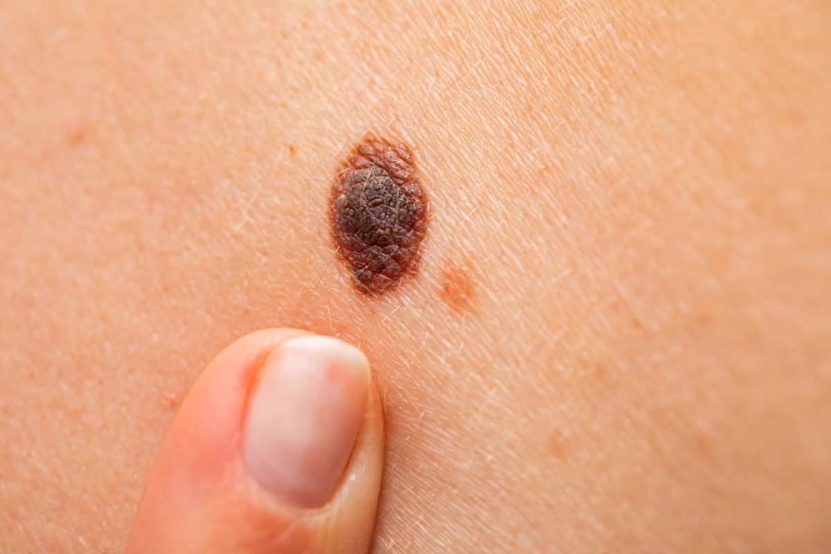 MELANOMA.jpg