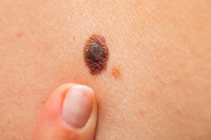 MELANOMA.jpg