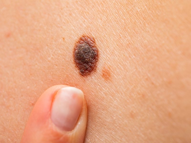 MELANOMA.jpg