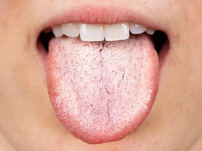 que-significa-tener-la-lengua-blanca-y-como-prevenirlo_1.jpg