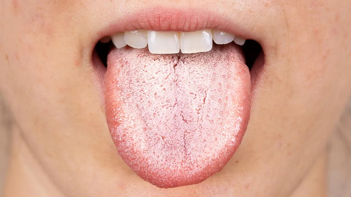 que-significa-tener-la-lengua-blanca-y-como-prevenirlo_1.jpg