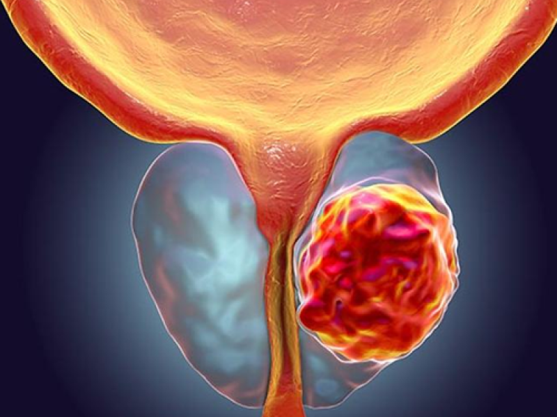 cancer-de-prostata.png