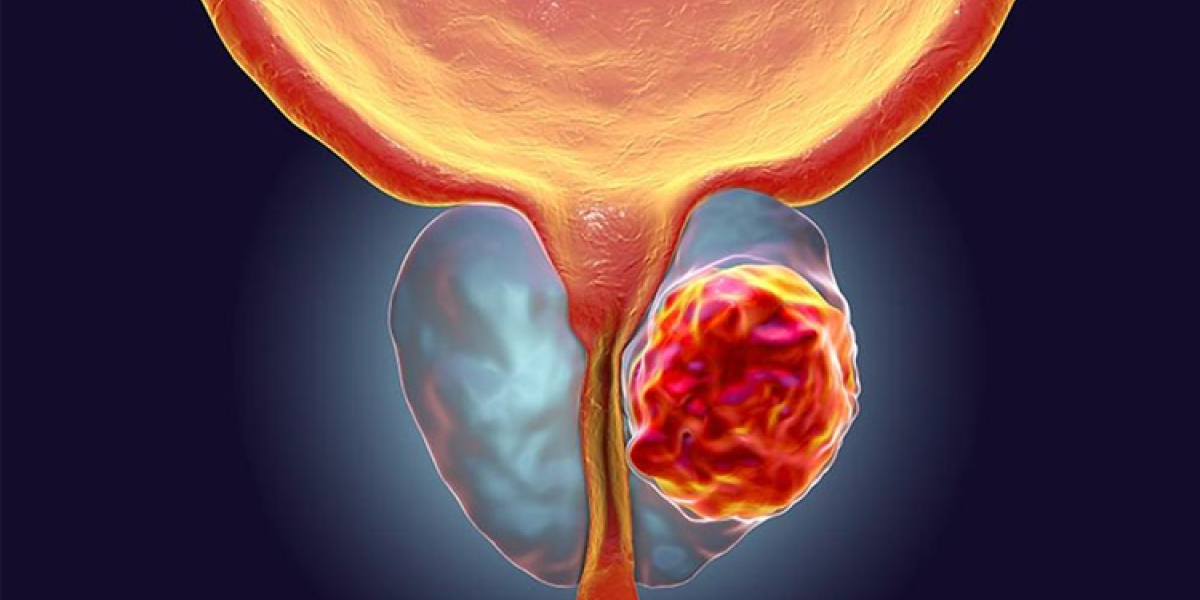 cancer-de-prostata.png
