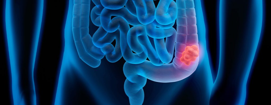 11-colorretal-intestino-reto-1.jpg
