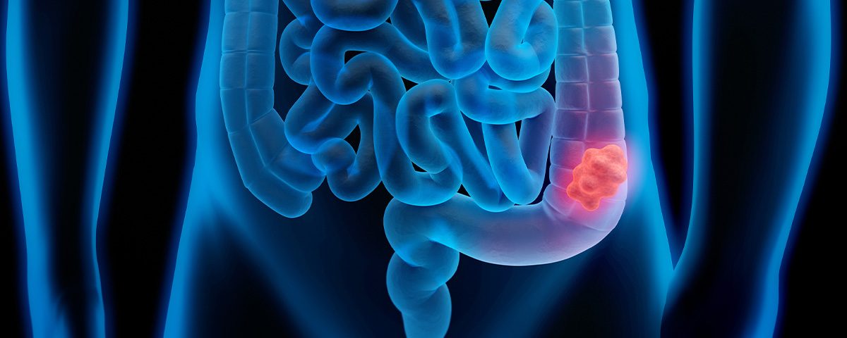 11-colorretal-intestino-reto-1.jpg