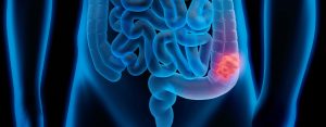 11-colorretal-intestino-reto-1.jpg