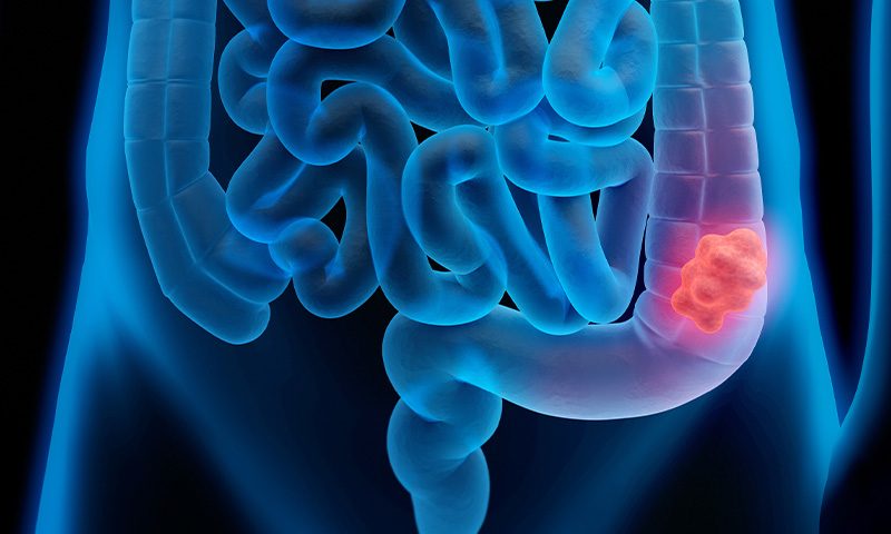 11-colorretal-intestino-reto-1.jpg
