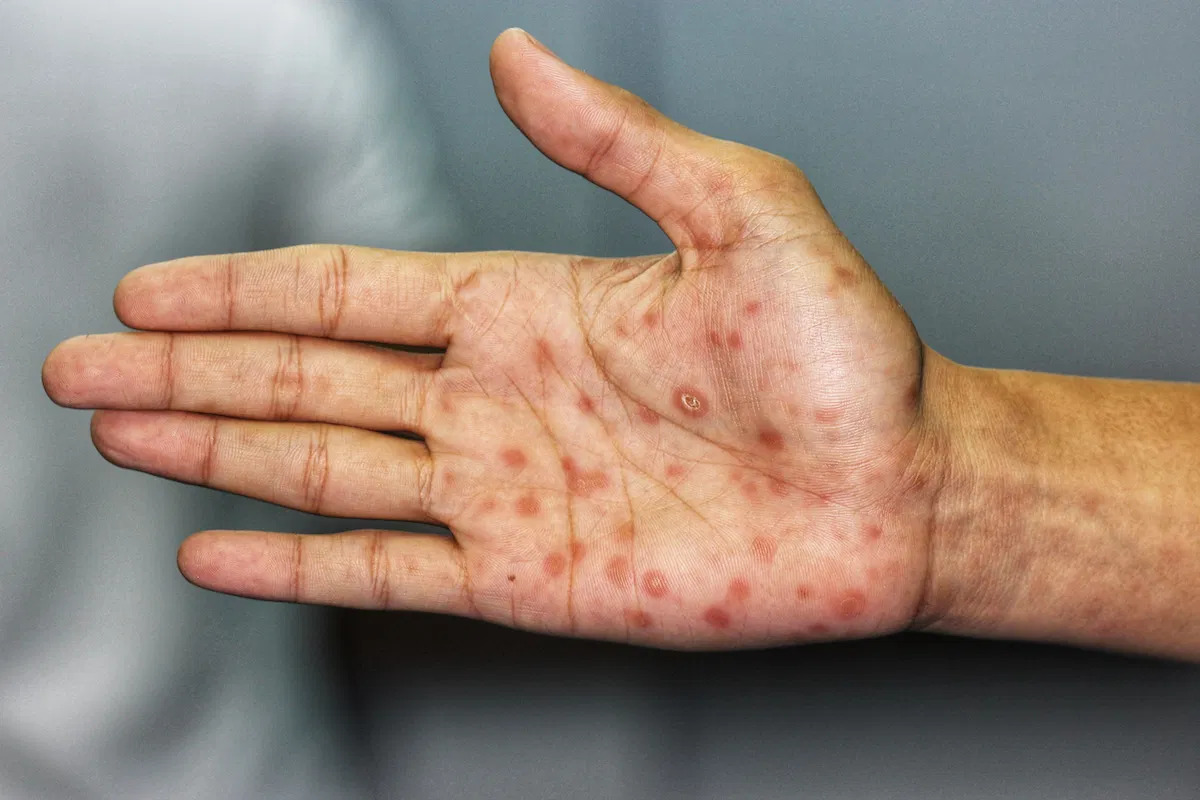 sifilis-secundaria_61090.jpg